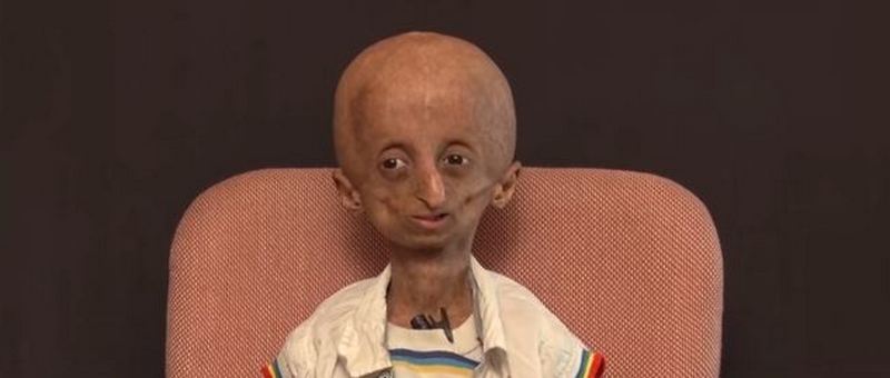 progeria patient